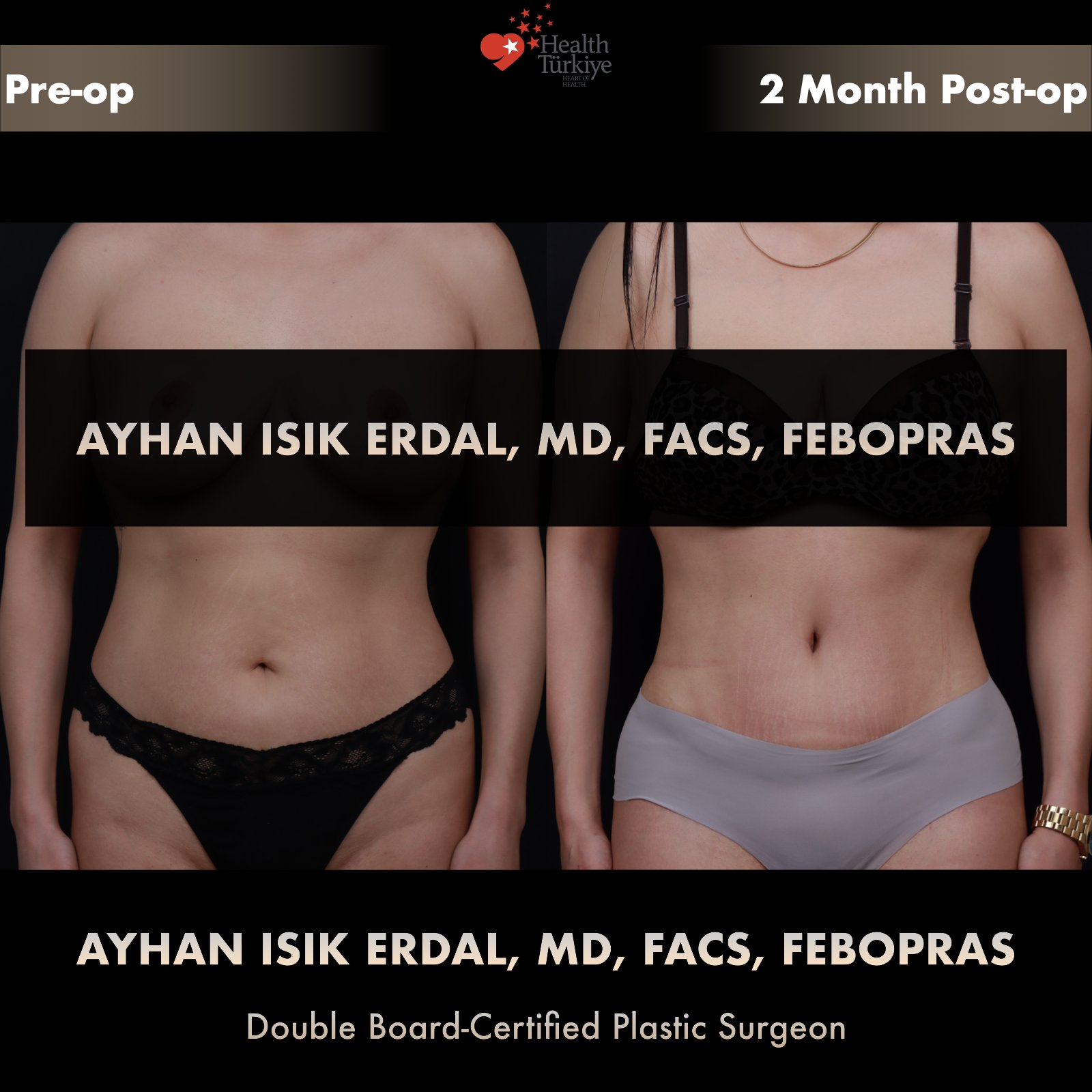 Standard abdominoplasty — frontal view, pre-operative vs 2 months post-operative comparison by Dr. Ayhan Işık Erdal