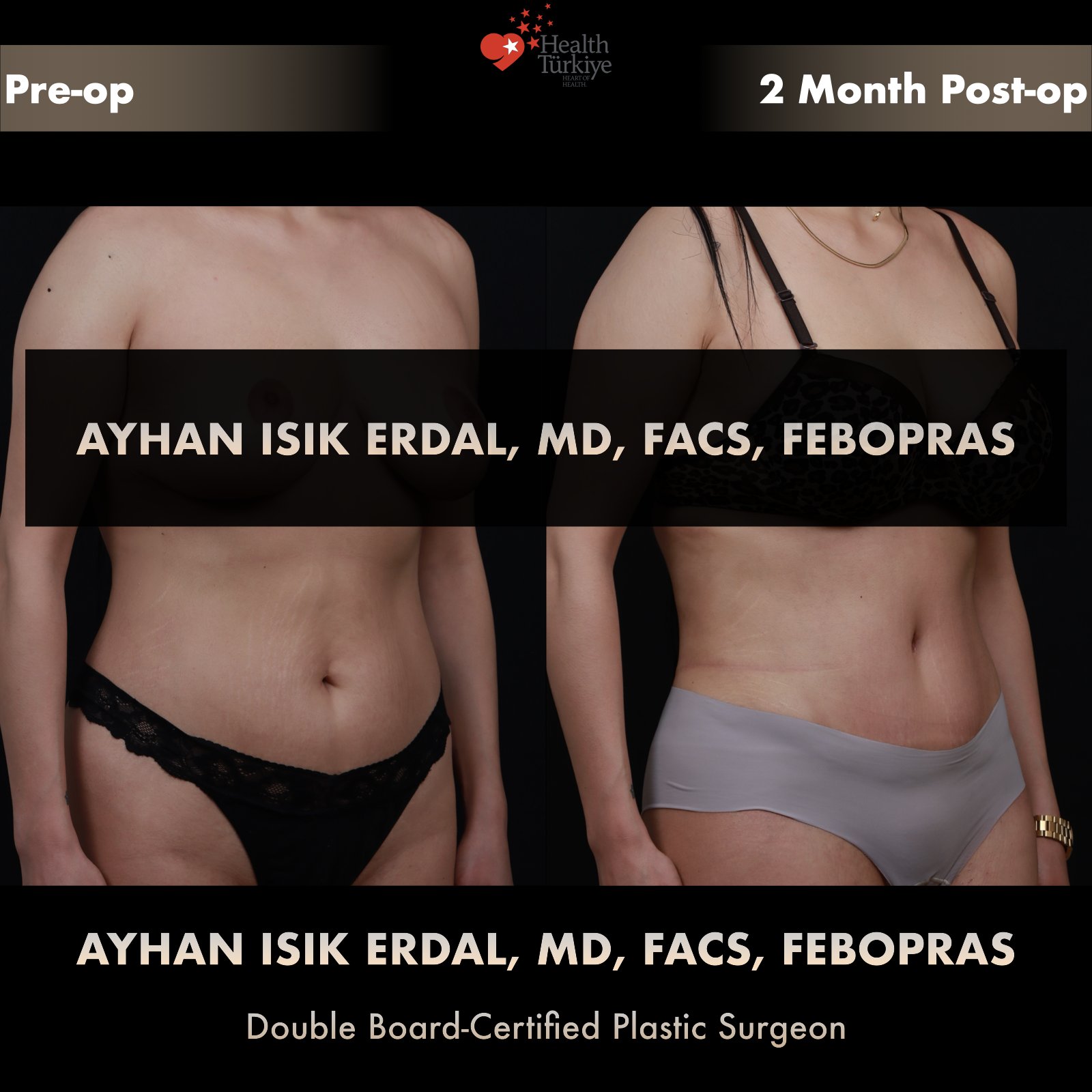 Standard abdominoplasty — oblique view, pre-operative vs 2 months post-operative comparison by Dr. Ayhan Işık Erdal