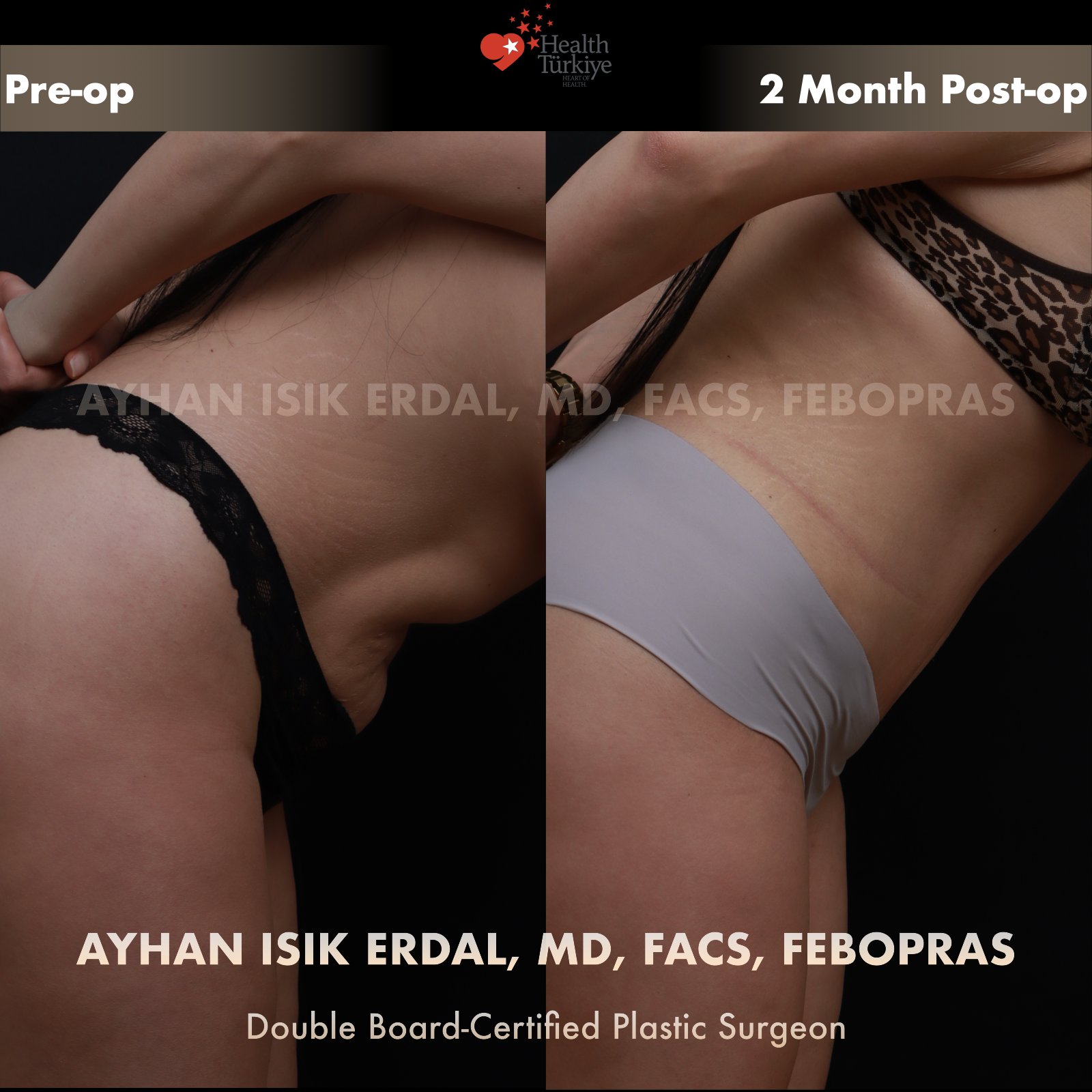 Standard abdominoplasty — dynamic/abdominal lift view showing pre-operative laxity, 2 months post-operative comparison by Dr. Ayhan Işık Erdal