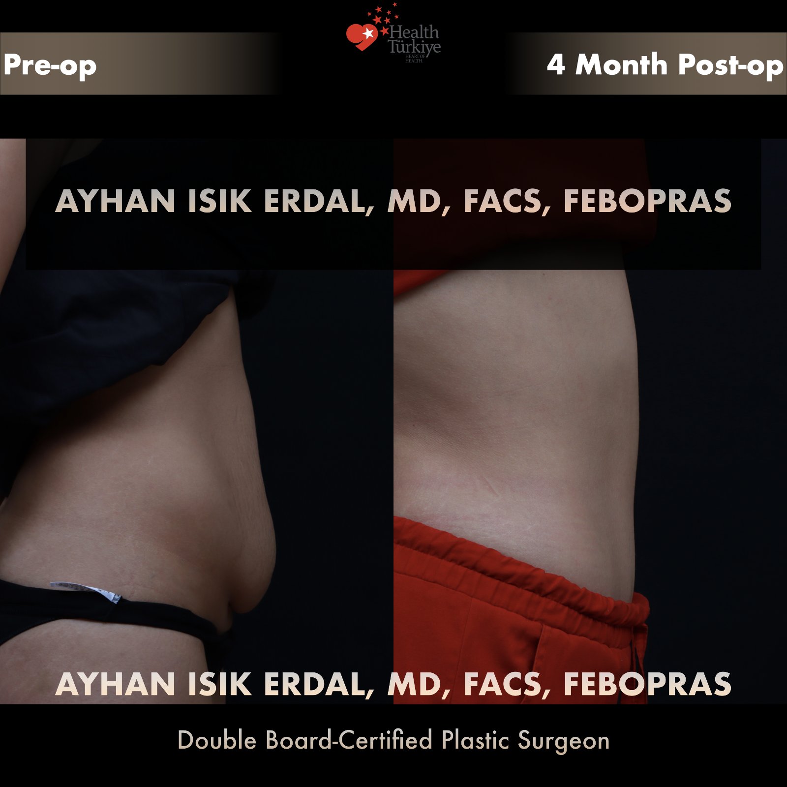 Post-pregnancy tummy tuck — oblique view, pre-operative vs 4 months post-operative comparison by Dr. Ayhan Işık Erdal