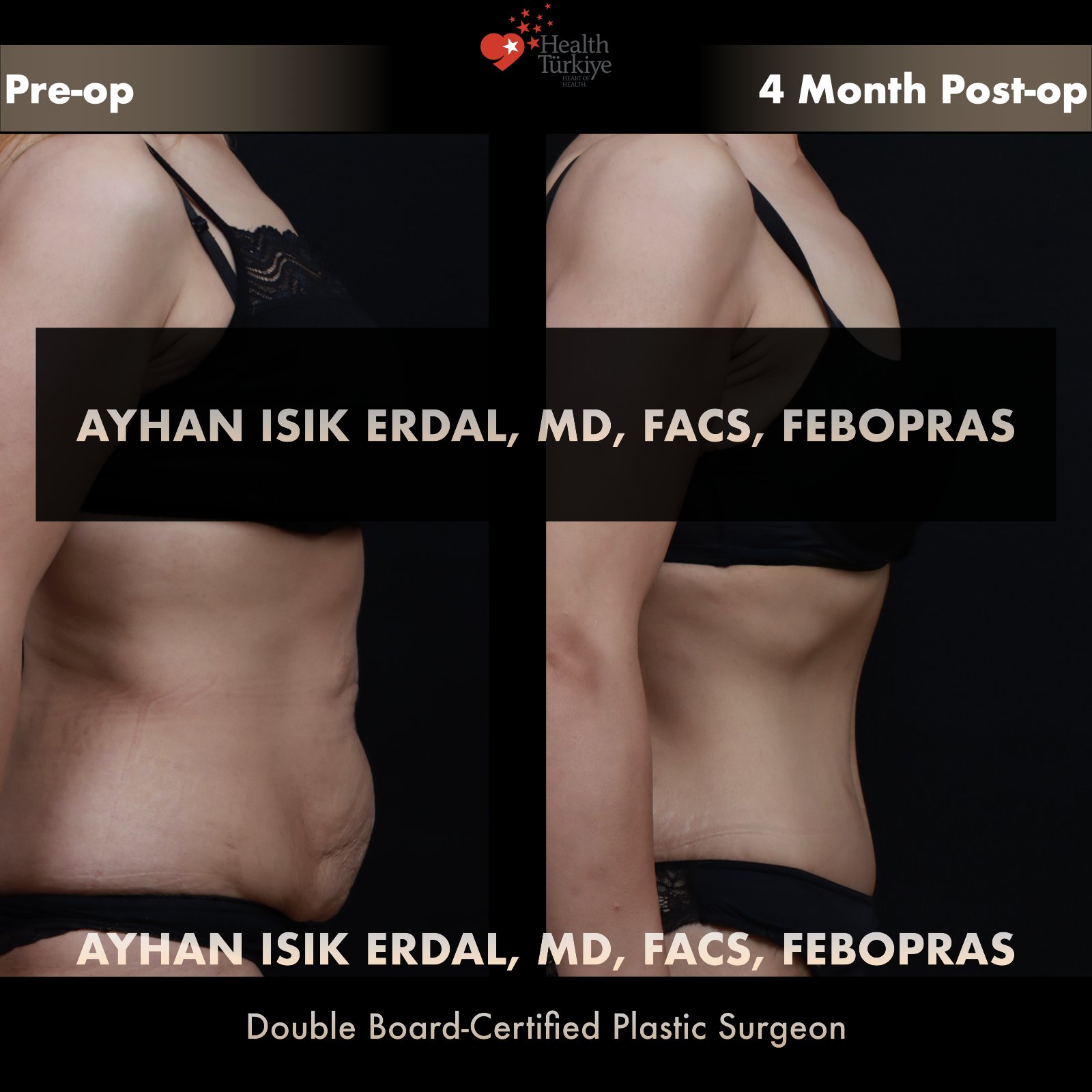 Standard abdominoplasty with significant skin laxity — lateral standing view, pre-operative vs 4 months post-operative comparison by Dr. Ayhan Işık Erdal