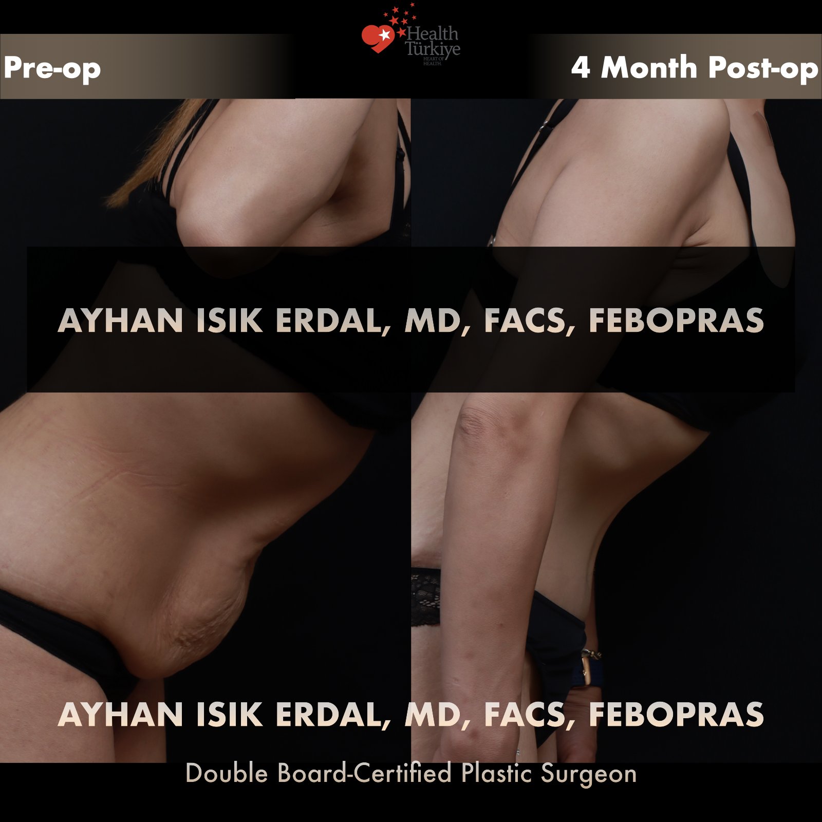 Standard abdominoplasty with significant skin laxity — lateral forward-bending view showing dynamic laxity, pre-operative vs 4 months post-operative comparison by Dr. Ayhan Işık Erdal
